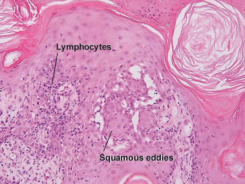 Fig. 2.11, Irritated and inflamed clonal seborrheic keratosis