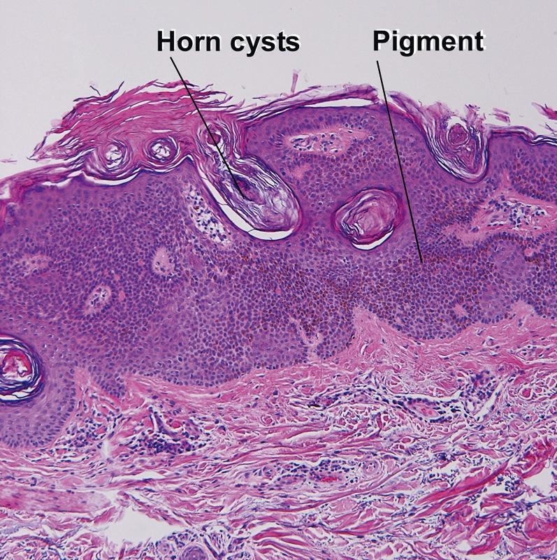 Fig. 2.14, Pigmented seborrheic keratosis