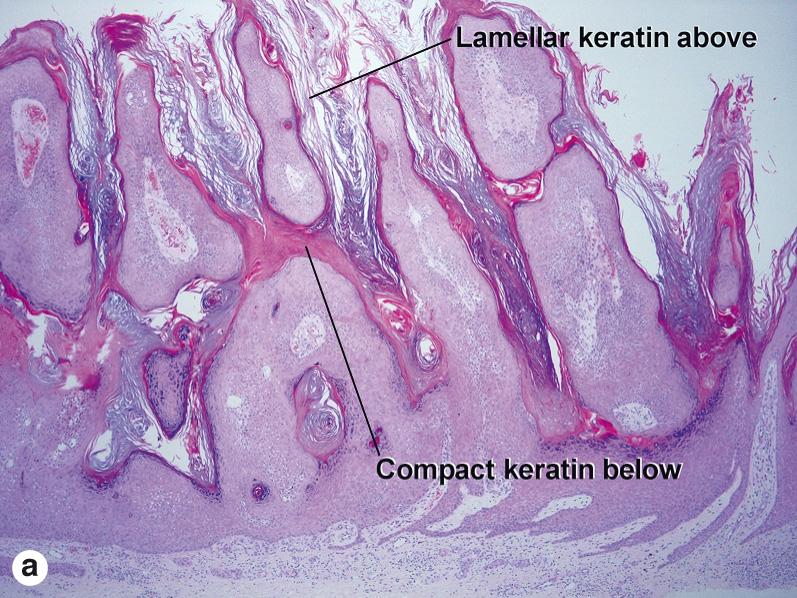 Fig. 2.15, Irritated seborrheic keratosis with prominent squamous eddies