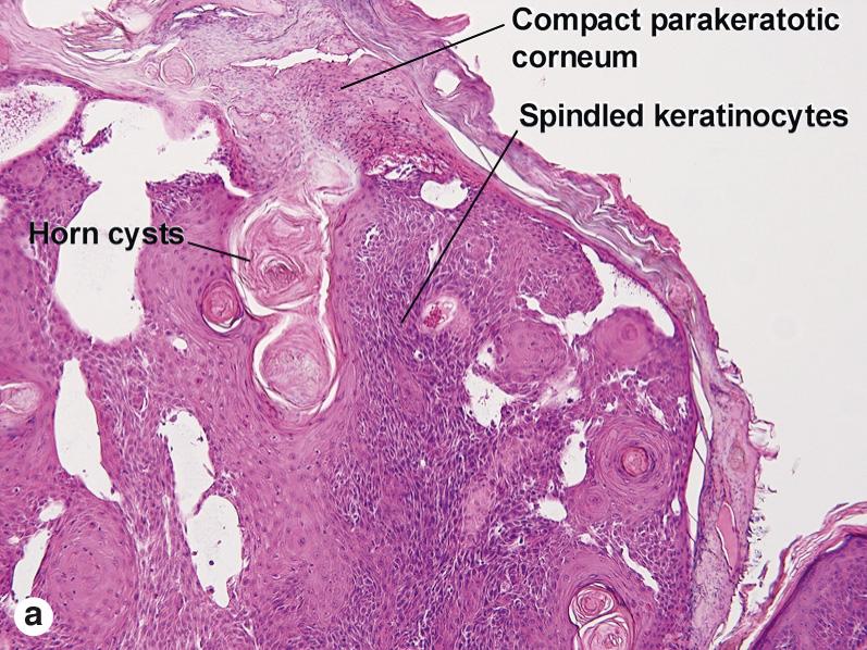 Fig. 2.16, Irritated seborrheic keratosis with prominent spindling of keratinocytes