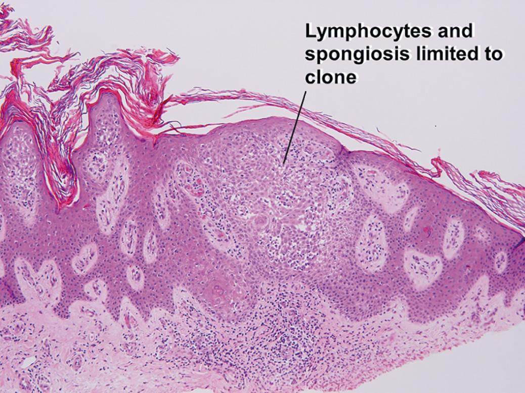 Fig. 2.17, Inflamed seborrheic keratosis with lymphocytes and spongiosis
