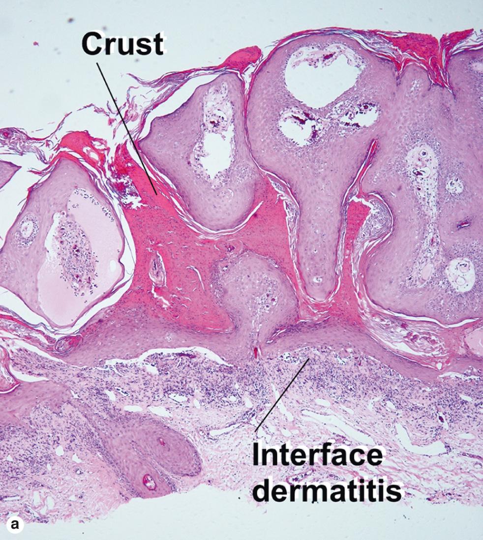 Fig. 2.18, Inflamed seborrheic keratosis with lichenoid interface dermatitis
