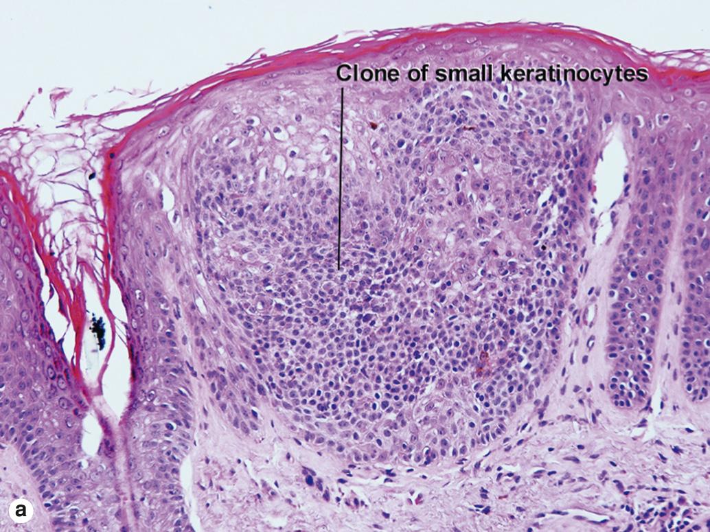 Fig. 2.19, Melanoacanthoma