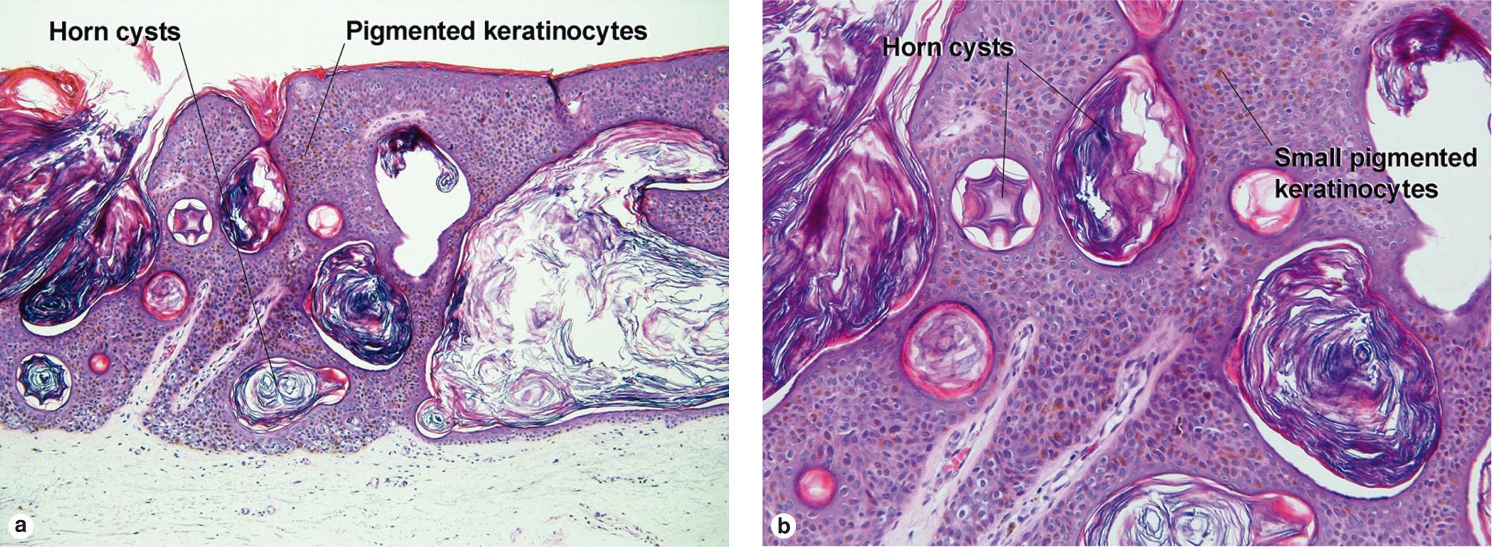 Fig. 2.2, Pigmented acanthotic seborrheic keratosis