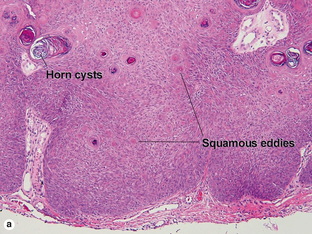 Fig. 2.3, Irritated acanthotic seborrheic keratosis