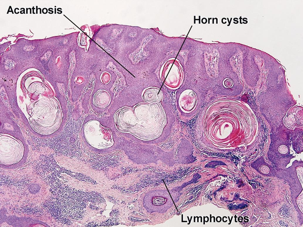 Fig. 2.4, Inflamed acanthotic seborrheic keratosis