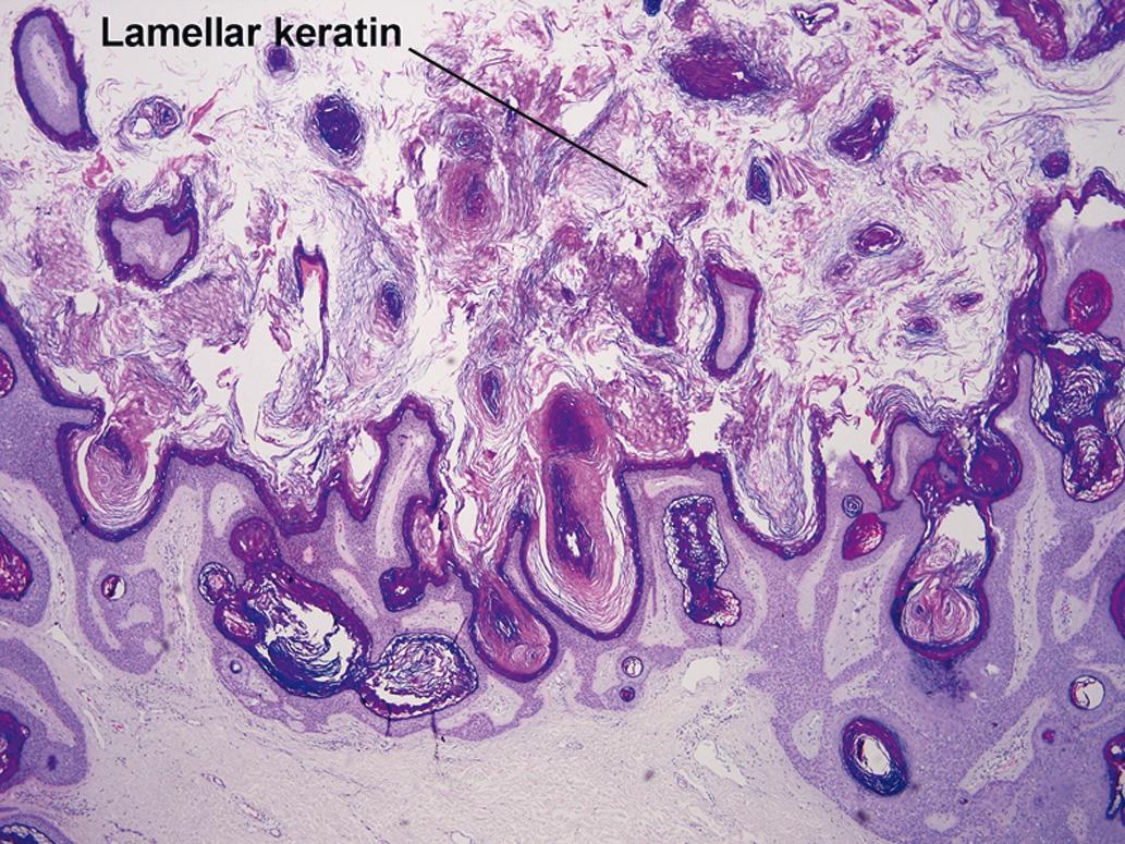 Fig. 2.5, Hyperkeratotic seborrheic keratosis