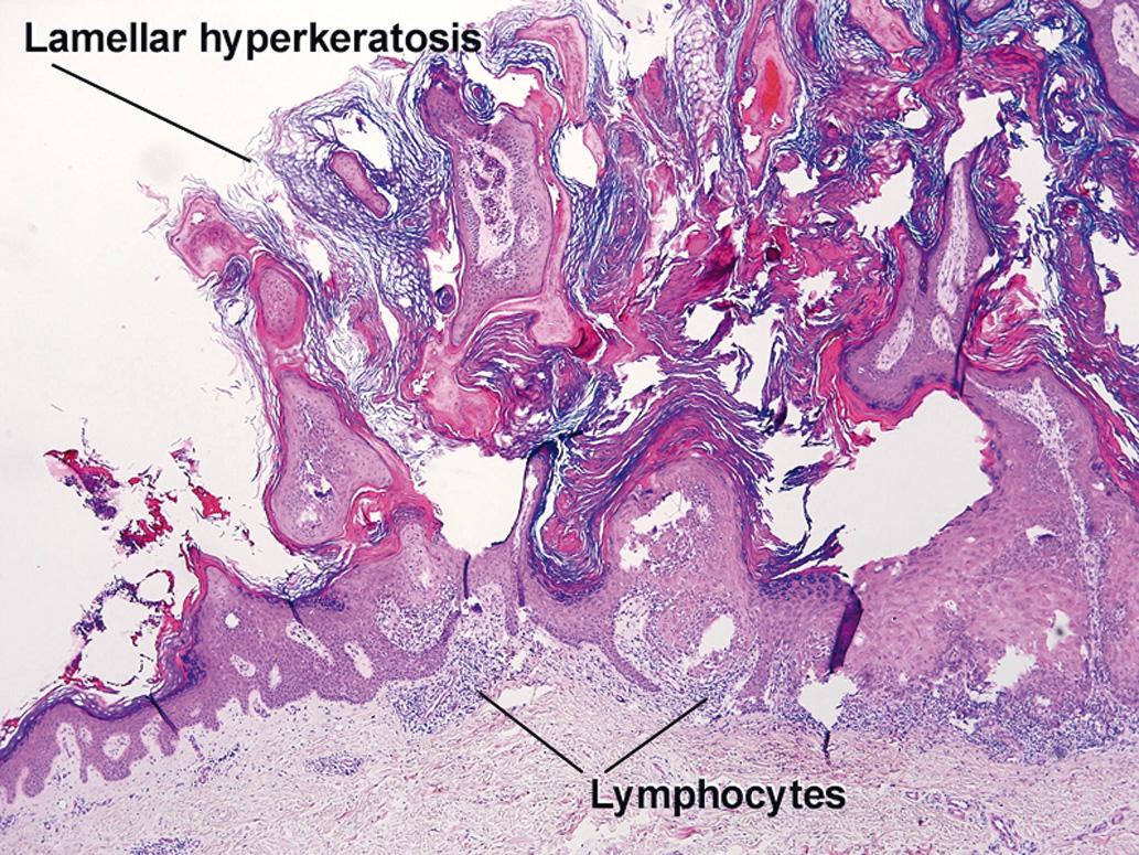 Fig. 2.6, Inflamed hyperkeratotic seborrheic keratosis