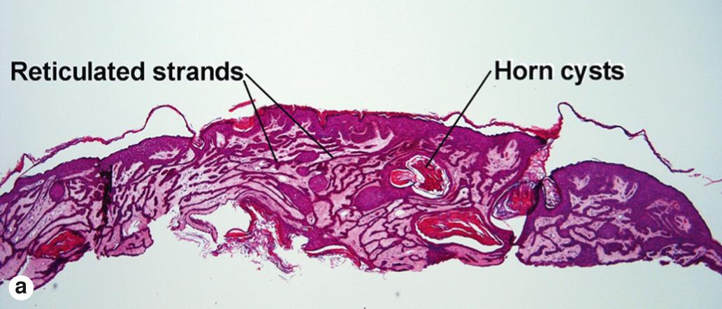 Fig. 2.7, Reticulated seborrheic keratosis. (For the differential diagnosis of Dowling–Degos disease, see Fig. 12.15 . For the differential diagnosis of solar lentigo, see Fig. 6.1 )