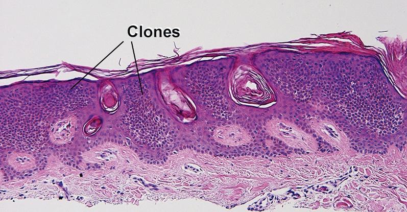 Fig. 2.8, Clonal seborrheic keratosis