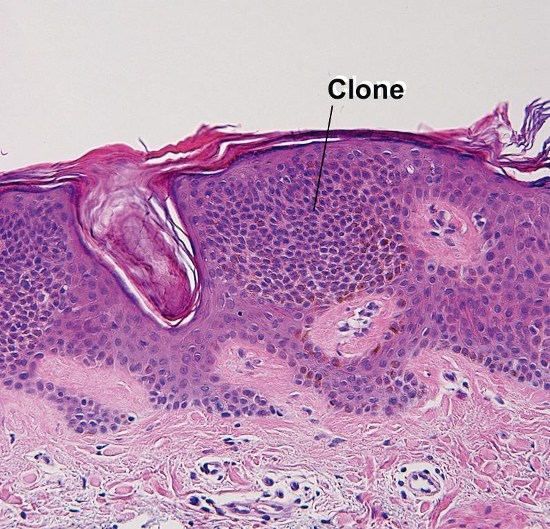 Fig. 2.9, Pigmented clonal seborrheic keratosis