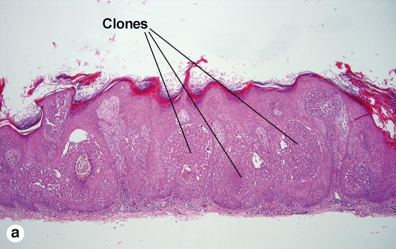 Fig. 2.10, Irritated clonal seborrheic keratosis