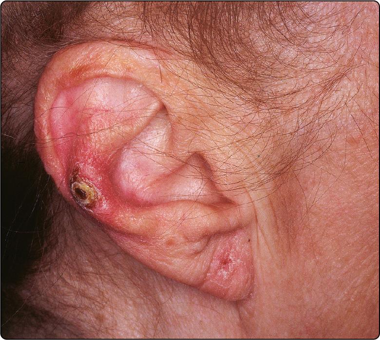Fig. 53.1, Chondrodermatitis nodularis on the antihelix of the pinna, showing typical inflammation and crusting.