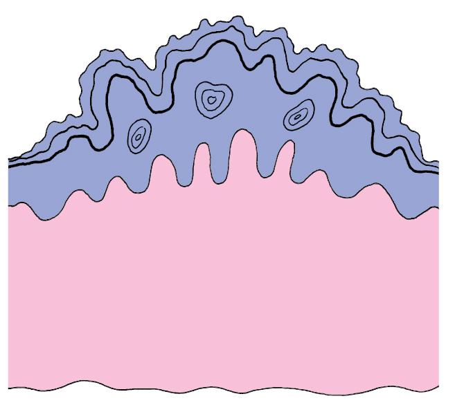 Fig. 52.1, Histopathology of seborrhoeic wart.