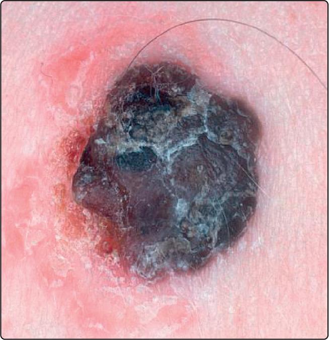 Fig. 52.3, An inflamed seborrhoeic wart, as shown here, may give rise to concern about the presence of malignant change.