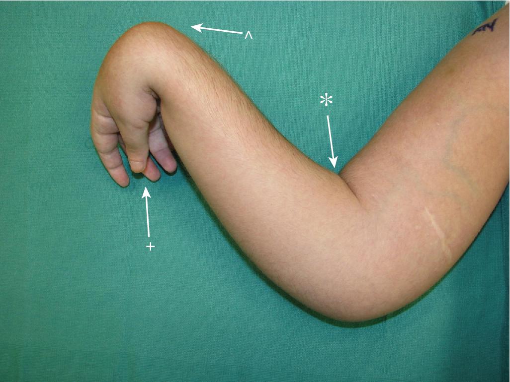 FIGURE 99.1, Common presentation of elbow spasticity consisting of elbow flexion (*), wrist flexion, forearm pronation (^), finger flexion, and thumb adduction (+).