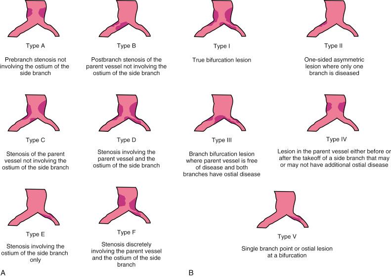 Fig. 23.1, Various classifications of bifurcations according to plaque distribution: Duke (A), Sanborn (B), Safian (C), Lefevre (D), SYNTAX study (E), Medina (F).