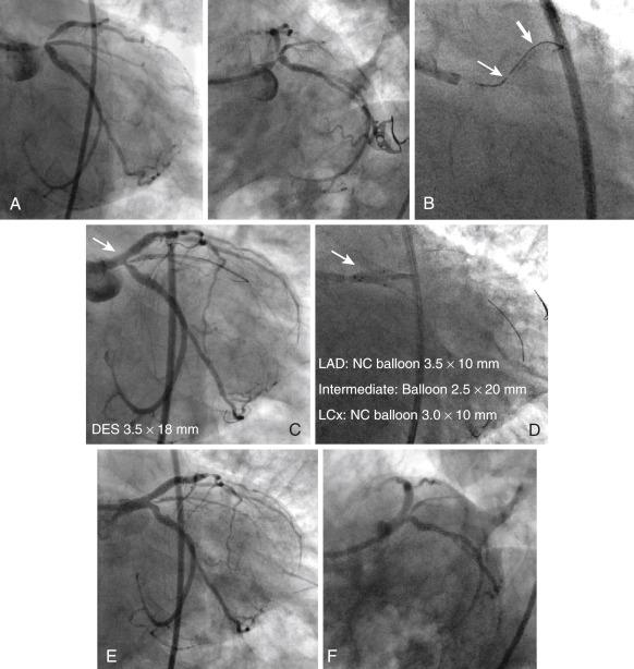 Fig. 23.4, Baseline angiogram presents large eccentric atherosclerotic plaque, which involves the distal part of the left main coronary artery (LMCA) and extends into the ostial segment of the left anterior descending (LAD) (A, caudal view; B, spider view). Because of a tight LMCA lesion and unfavorable access to the ostial LAD, a Venture wire control catheter (Vascular Solutions, Minneapolis, MN) (arrow) was used to insert a coronary guidewire (thick arrow) (C). After that, two guidewires were inserted in intermediate branch and left circumflex (LCx) . Following predilatation of the LMCA/ostial LAD lesion, a drug-eluting stent was implanted from the ostium of LMCA toward LAD (D), and final kissing balloon inflation was performed with three balloons, positioned from left main to LAD, intermediate branch and LCx (E). Panel E presents final angiographic result. DES, drug-eluting stent; NC , noncompliant balloon.