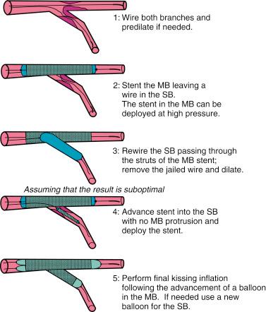 Fig. 23.5, A schematic representation of the T technique.