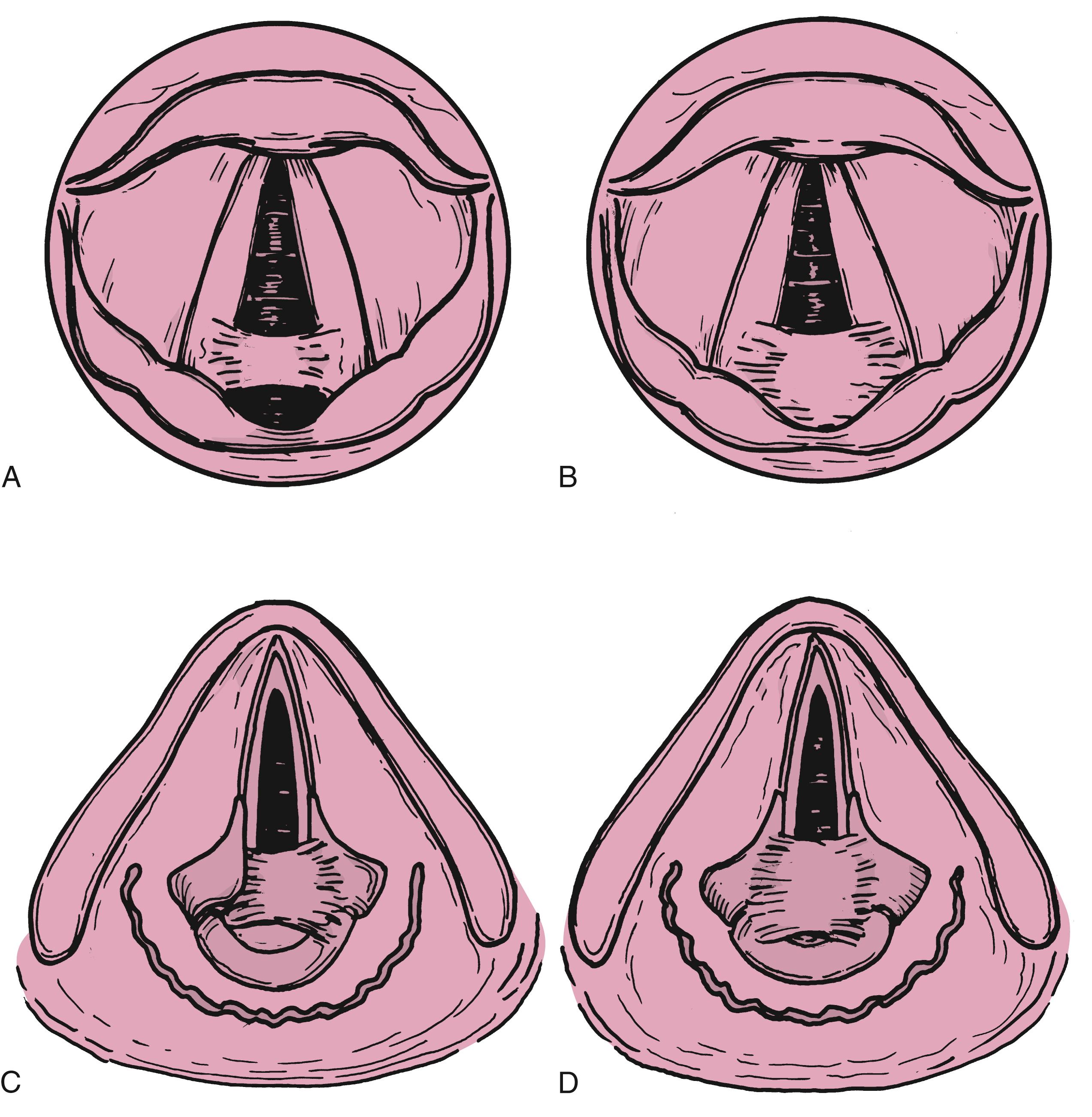 Fig. 9.1, Grading of posterior glottic stenosis.