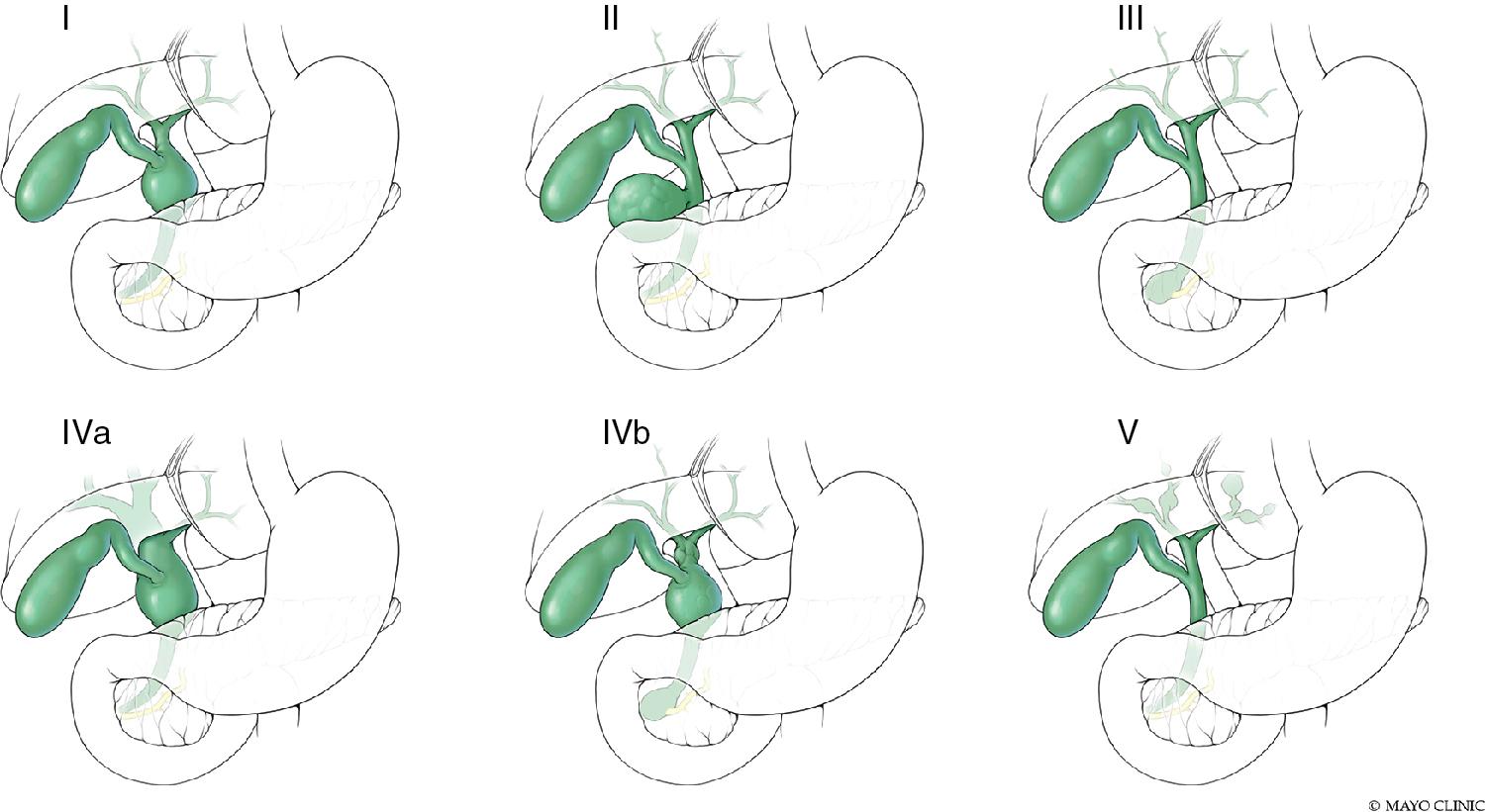 FIGURE 46.1, Classification of bile duct cysts.