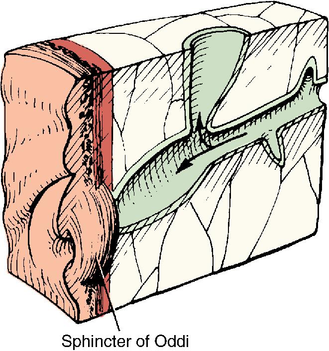 FIGURE 46.3, A long common channel in the pancreaticobiliary ductal confluence is the most accepted cause of choledochal cysts.