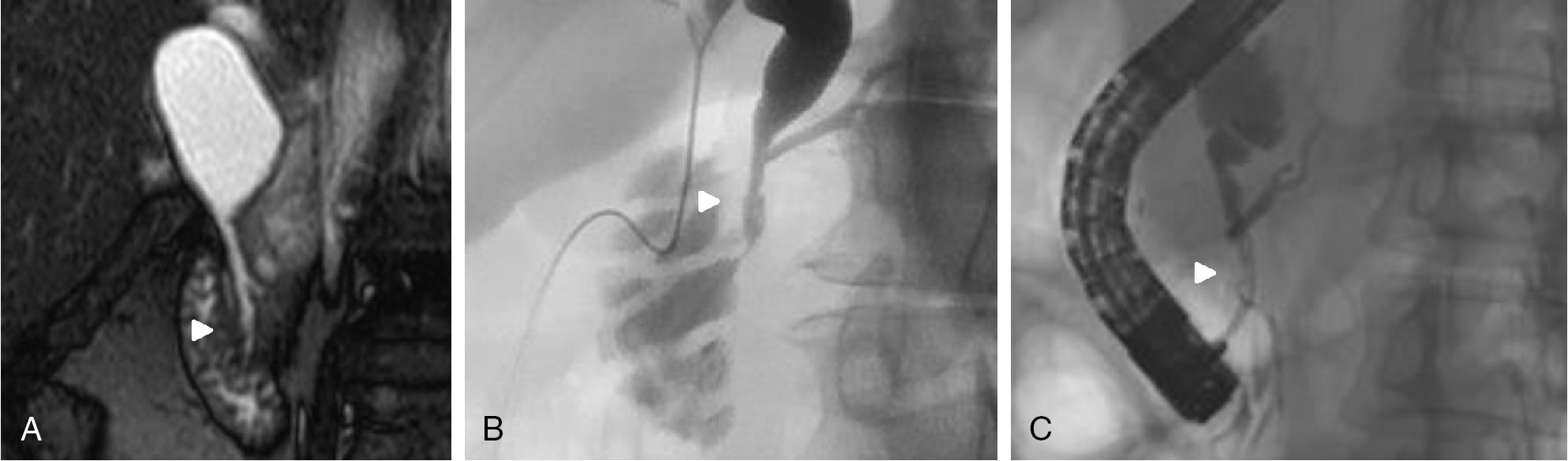 FIGURE 46.4, A long common channel, a characteristic finding in biliary cyst patients, is seen via magnetic resonance imaging (MRI; see Chapter 16 ) (A) and endoscopic retrograde cholangiopancreatography (ERCP; see Chapters 20 and 30 ) (B and C) as marked by the white arrowhead .