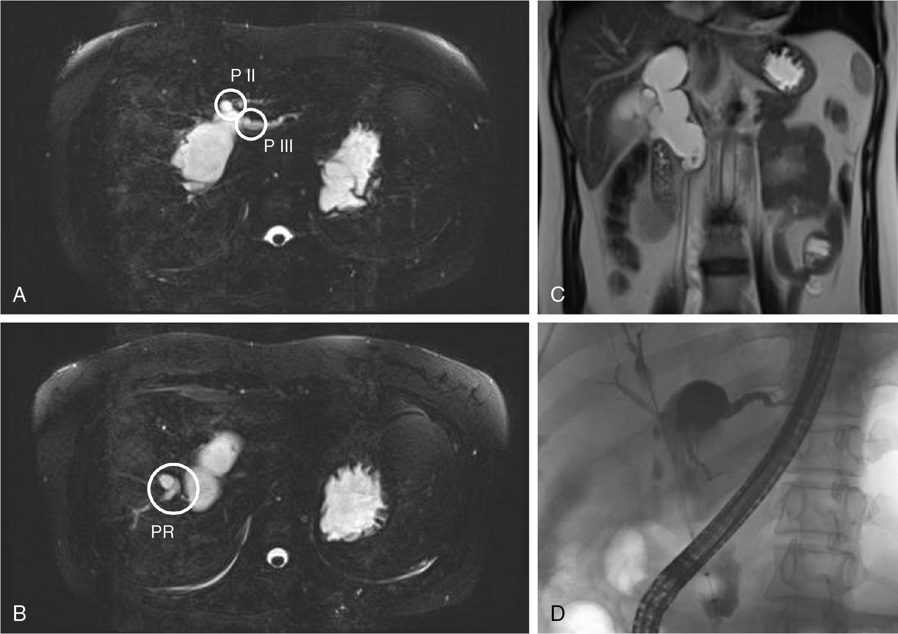 FIGURE 46.5, Detailed preoperative workup of a patient with a type IVa biliary cyst utilizing magnetic resonance imaging (MRI).