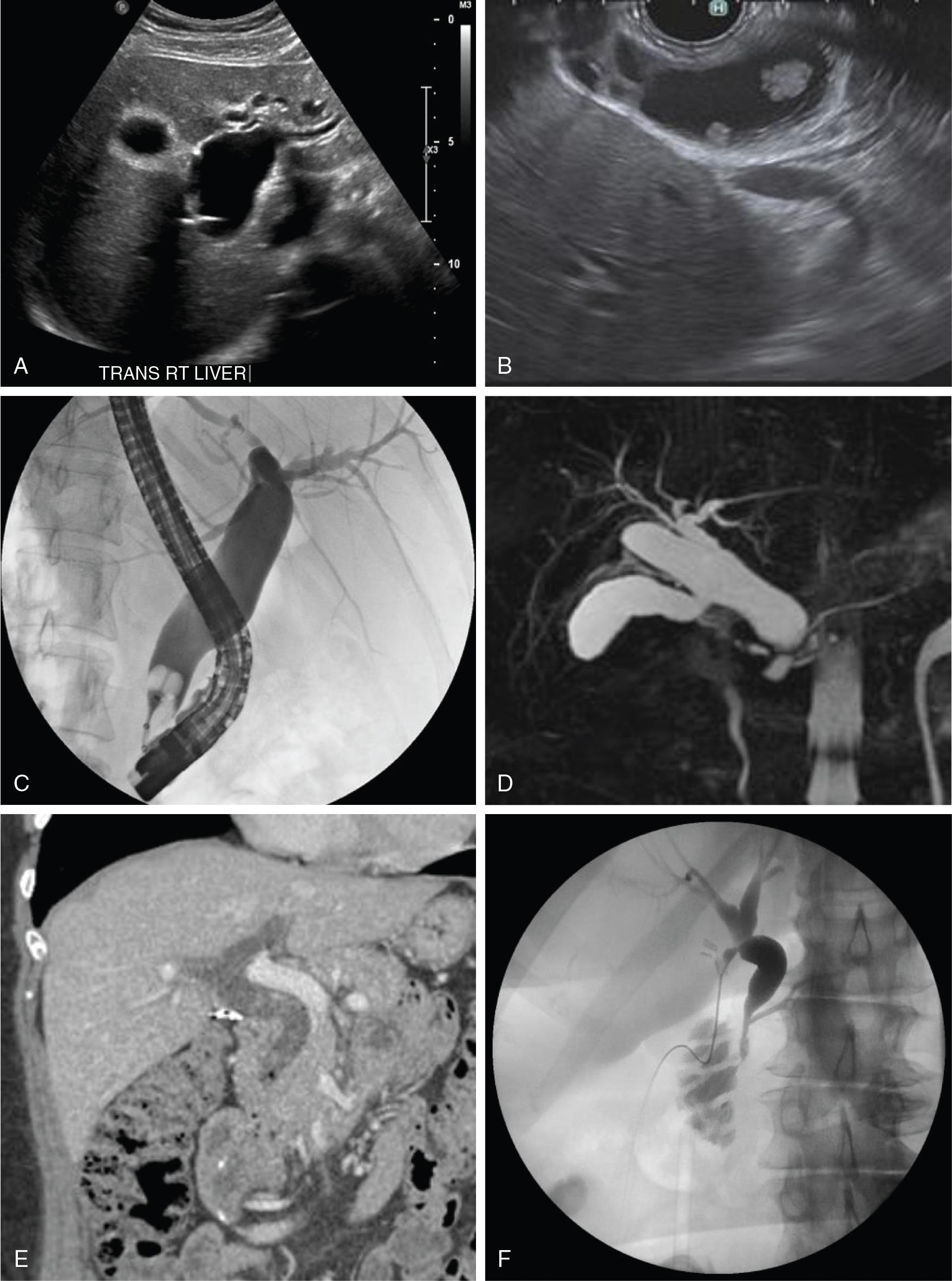 FIGURE 46.6, Commonly applied imaging modalities for biliary cysts (see Chapters 16 , 20 , and 30 ).