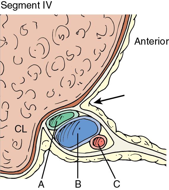 FIGURE 32.2, Sagittal section showing the relationship of segment IV and caudate lobe to the left portal triad, which is encased within a reflection of the lesser omentum that fuses with the Glisson capsule at the base of segment IV.