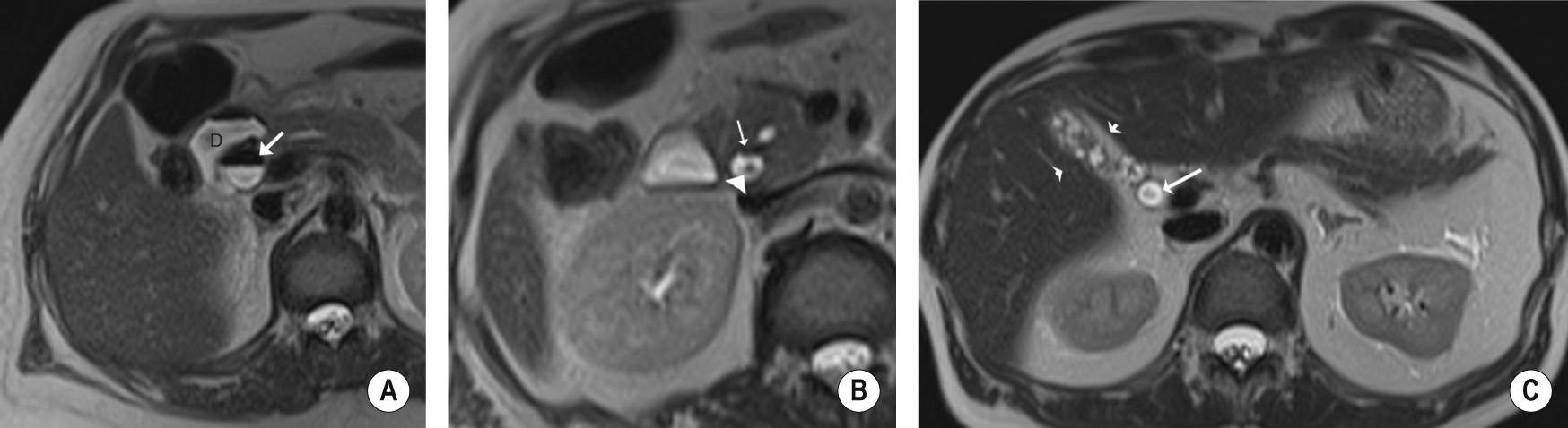 Example of intraductal factors causing potential pitfalls in interpretation. (A) Axial T2-weighted MRI shows an air-fluid level in a dilated proximal CBD in keeping with aerobilia (arrow), adjacent to the duodenum (D), which also shows an air-fluid level. (B) More distally in the same patient, the cause of the obstruction is seen with a dependent filling defect (arrowhead) in the distal CBD in keeping with a stone. This should not be confused with the non-dependent aerobilia also shown at this level (arrow). (C) Axial T2-weighted MRI in a different patient shows a central filling defect in a dilated CBD which is due to flow artefact (arrow). The patient also has chronic cholecystitis with a contracted gallbladder (arrowheads).