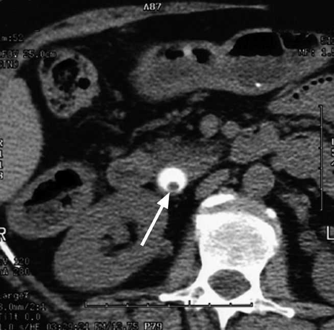 Choledocholithiasis. CT-IVC shows a small stone within the opacified distal common bile duct. *