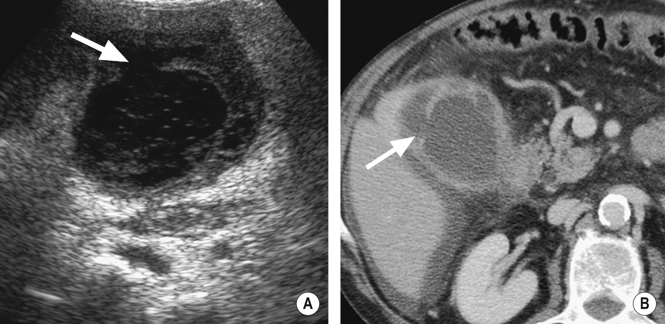 Acute cholecystitis with localized perforation on (A) US and (B) CT. The thickened gallbladder wall shows a local defect (arrow) and on CT there is small amount of intraperitoneal fluid and oedema of adjacent fat. *