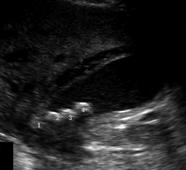 Acute cholecystitis. The gallbladder contains small stones in the neck (Nos 1–4) and its wall shows oedematous thickening (5 mm thickness). *