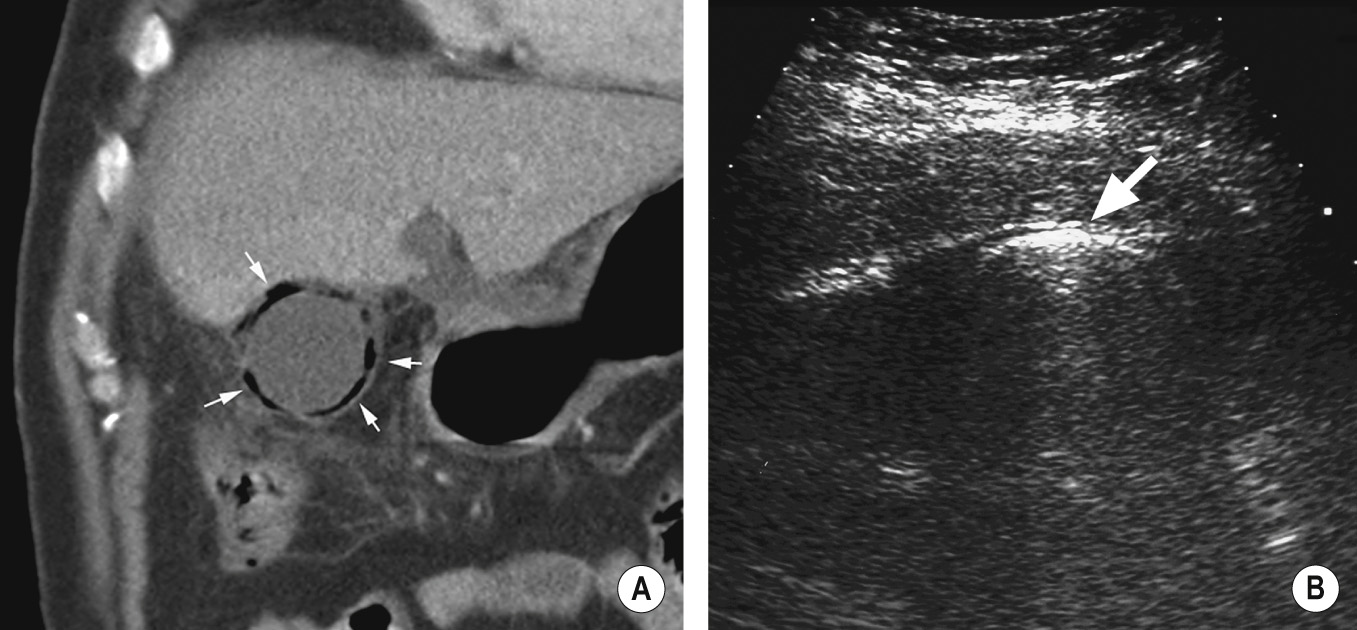 Emphysematous cholecystitis. (A) Coronal CT – intramural gas (arrows) ** ▸ (B) US – intraluminal gas appears as a bright curvilinear echogenic band (arrow) with ‘dirty’ shadowing. *