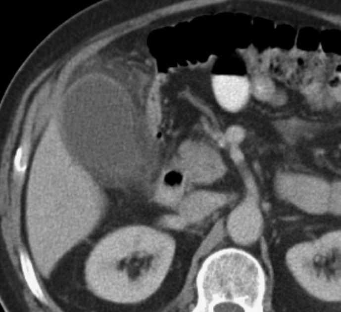 Acute cholecystitis on CT. The gallbladder wall is thickened with oedema in the adjacent fat. *