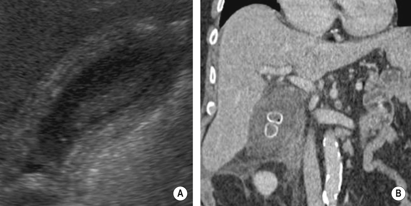 Acute cholecystitis. (A). US demonstrating a thickened inflamed gallbladder wall. (B) Coronal CT demonstrating marked pericholecystic inflammatory stranding with laminated calcified gallstones in situ.