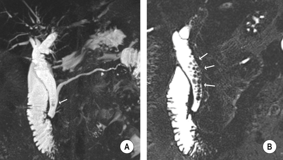 Example of a partial voluming artefact. (A) Coronal maximum intensity projection (MIP) reformat shows a possible filling defect (arrow) in the dilated distal CBD. (B) The thin section MRCP source image in fact demonstrates multiple filling defects (arrows) in the CBD, in keeping with stones.