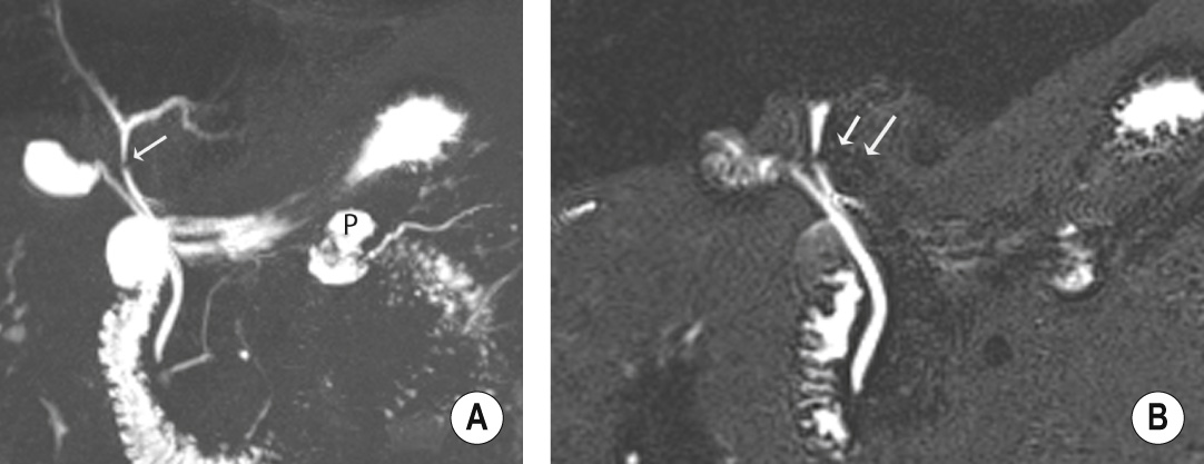 (A) Coronal MIP reformat suggests a stricture or possible filling defect in the common hepatic duct (arrow) but with no upstream dilatation. Incidental note is also made of a small pseudocyst (P) associated with the main pancreatic duct. (B) Thin-section MRCP image more clearly shows that this is due to extrinsic compression from the right hepatic artery, which appears as a subtle curvilinear signal void outside the duct and extending across it (arrows).
