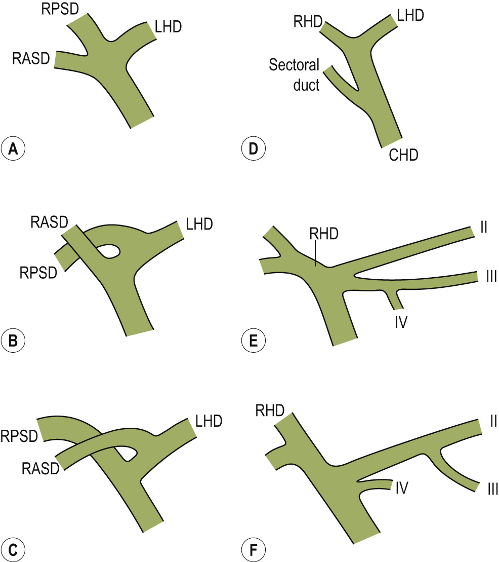 Variations of biliary branching patterns. The more common are A, B and C. Segments are numbered according to the system of Couinaud. CHD = common hepatic duct, RHD = right hepatic duct, LHD = left hepatic duct, RPSD = right posterior sectoral duct, RASD = right anterior sectoral duct. **