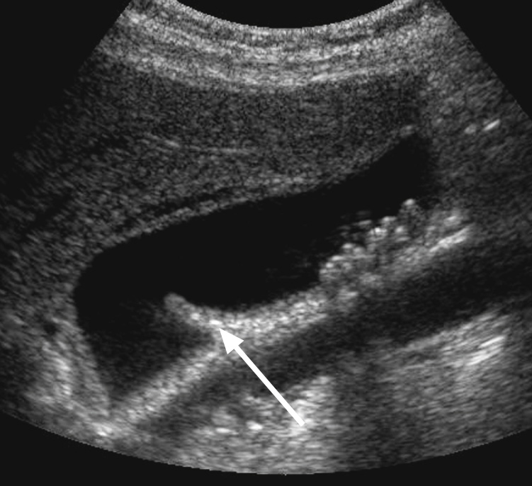 US shows multiple small shadowing stones. A normal fold (arrow) lies near the gallbladder neck. *