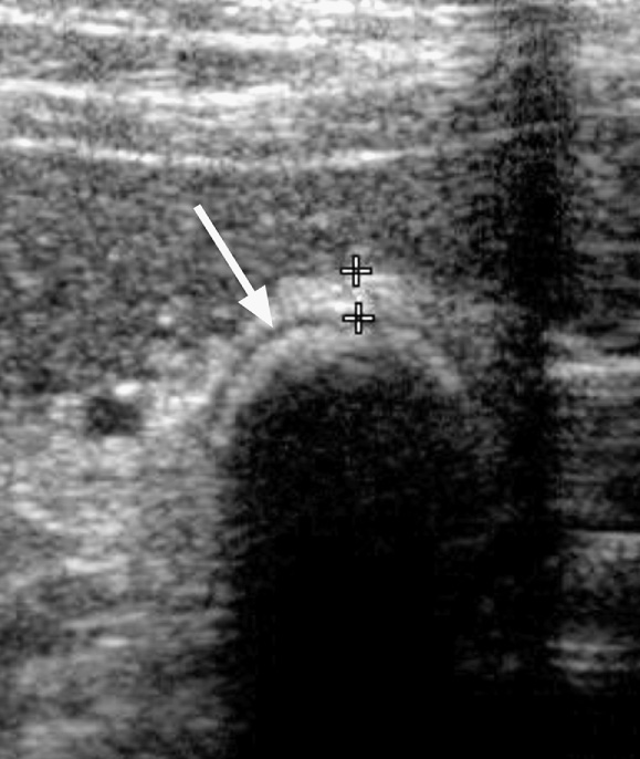 Gallbladder filled with stones producing the ‘double-arc’ sign ▸ hypoechoic line between two echogenic lines (arrow). *