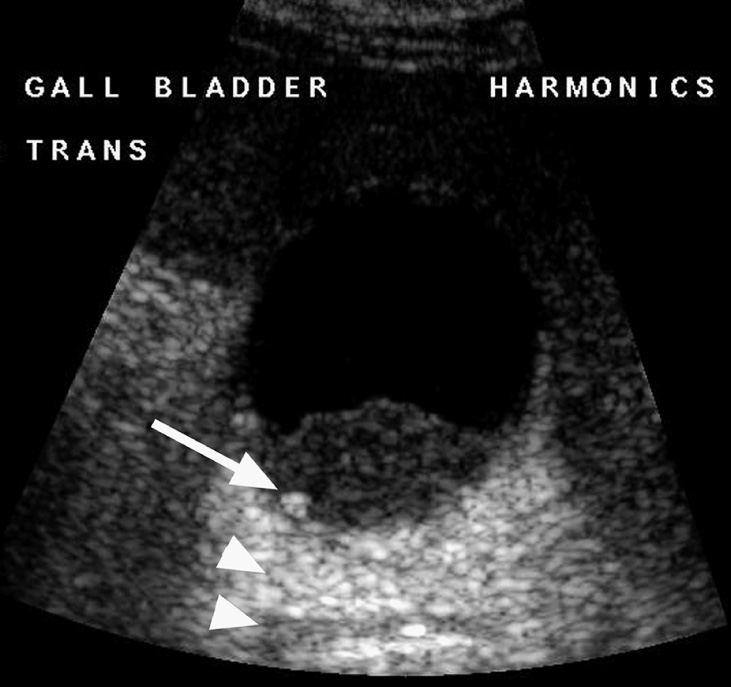 Sludge within which a small stone (arrow) casts a subtle acoustic shadow (arrowheads). *