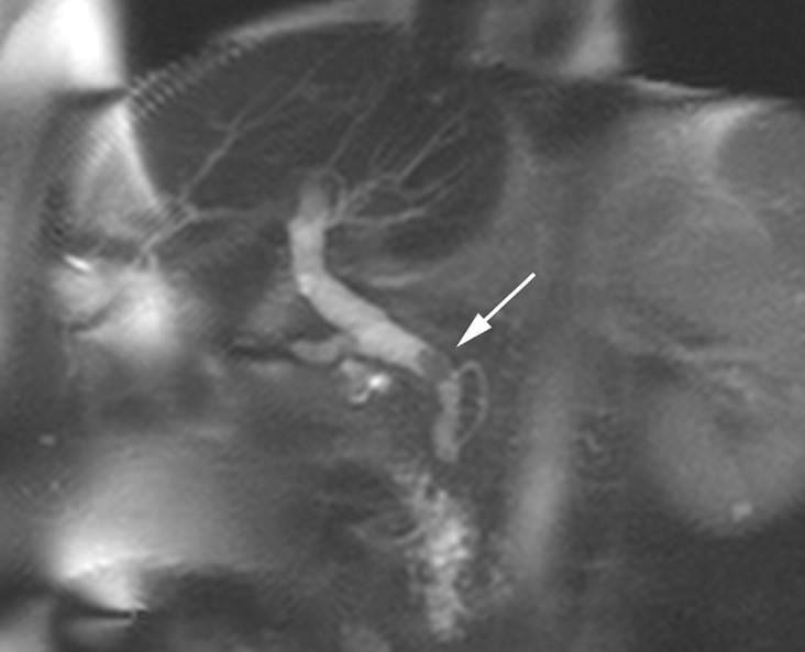 Choledocholithiasis. Single common duct stone (arrow) on thick-section, oblique, coronal MRCP. **