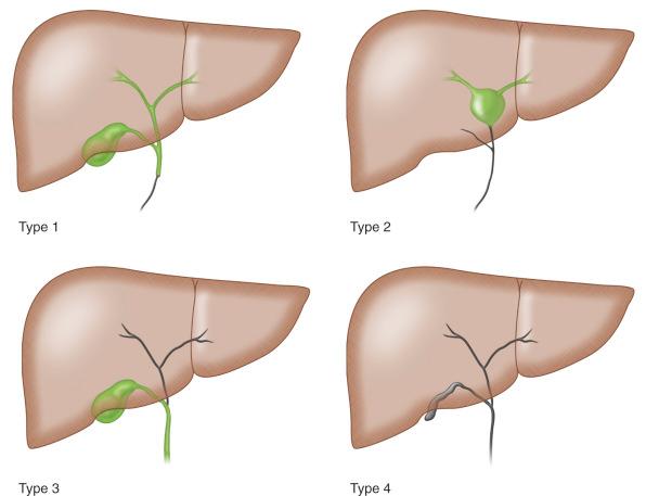 Fig. 25.1, French classification of biliary atresia. Type 1, Atresia limited to common bile duct; type 2, cyst in the liver hilum communicating with dystrophic intrahepatic bile ducts; type 3, hepatic duct atresia; gallbladder, cystic duct, and common bile duct patent; type 4, complete extrahepatic biliary atresia.