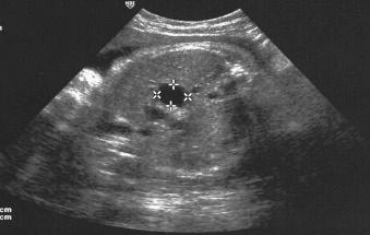 Fig. 25.2, Biliary atresia. Prenatal ultrasound at 31 weeks' gestation with a cystic structure on the caudal surface of the liver (calipers indicating size of 15 mm × 16 mm).