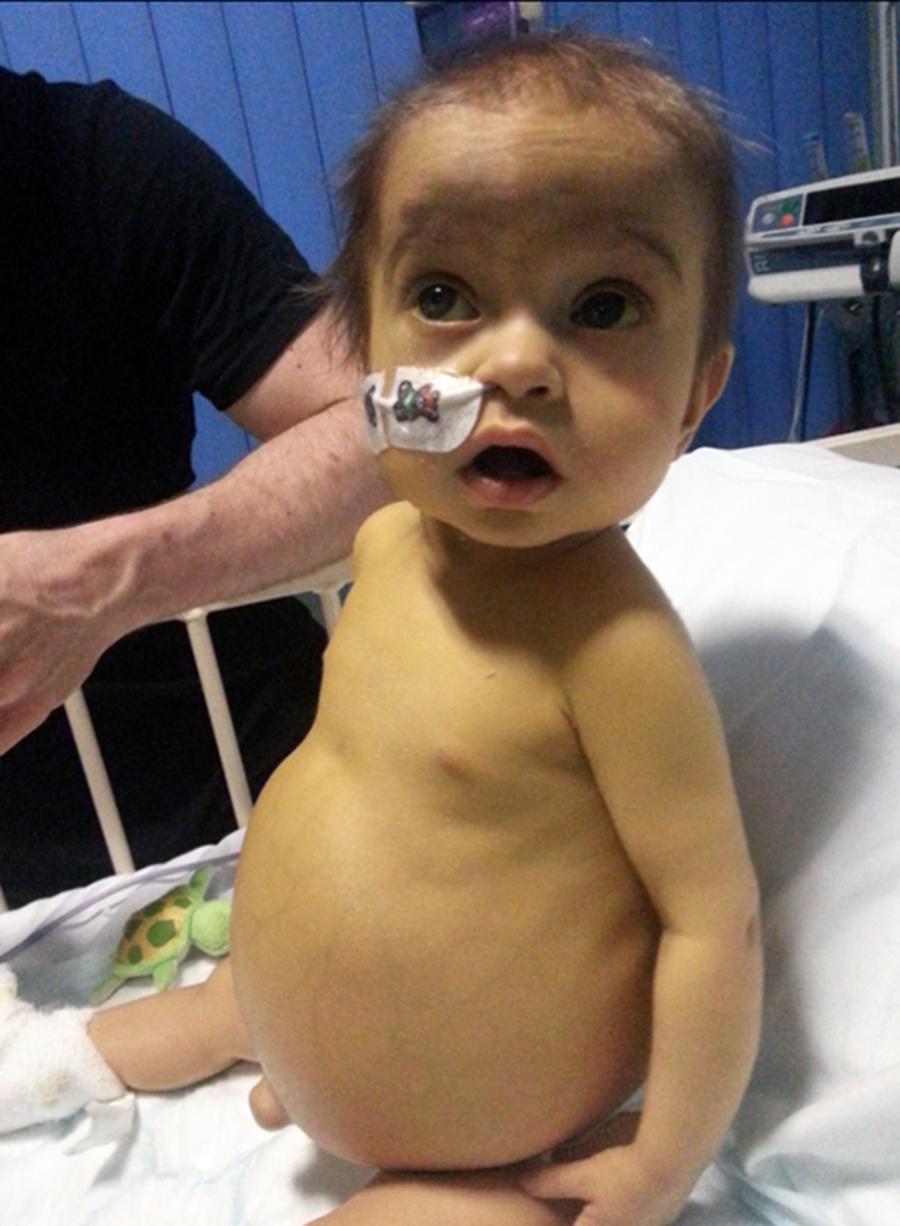 Fig. 34.1, A child with biliary atresia with a failed Kasai procedure. Shown is jaundice, a distended abdomen attributed to ascites, with protrusion of the umbilicus, and prominent abdominal veins. The abdomen is distended by ascites; the child’s arms and legs show cachexia because of her severe liver disease, despite receiving supplemental nasogastric tube feeding.