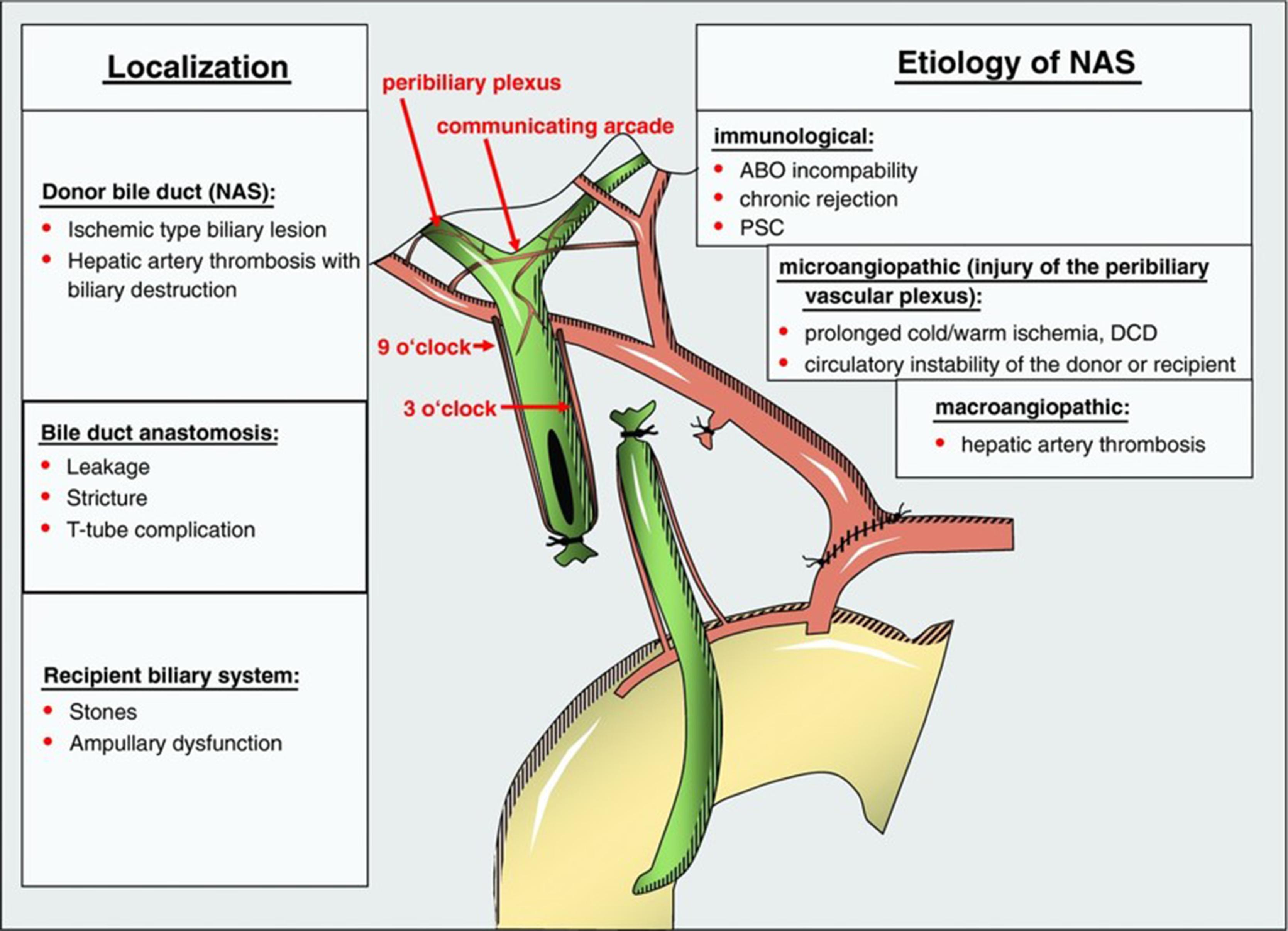 Fig. 21.2, Blood supply of the bile ducts after liver transplantation, classification of biliary complications, and etiology of nonanastomotic strictures.