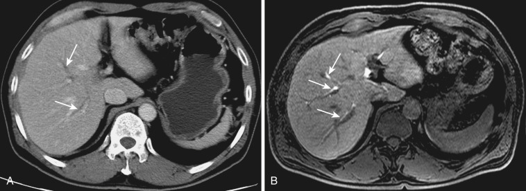 FIG 42-1, A, High-resolution CT shows normal intrahepatic bile ducts (IHDs) (arrows) as linear water-density structures accompanying the portal vein branches. B, T1-weighted MRI after administration of gadobenate dimeglumine demonstrates IHDs (arrows) with biliary excretion of contrast material located anterior to the portal veins.