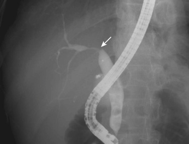 FIG 42-11, Multiple stones formed in the common bile duct. There is a tight stricture at the confluence of the bile ducts (arrow). This patient underwent cholecystectomy 10 years ago, so the stones formed in the common bile duct.